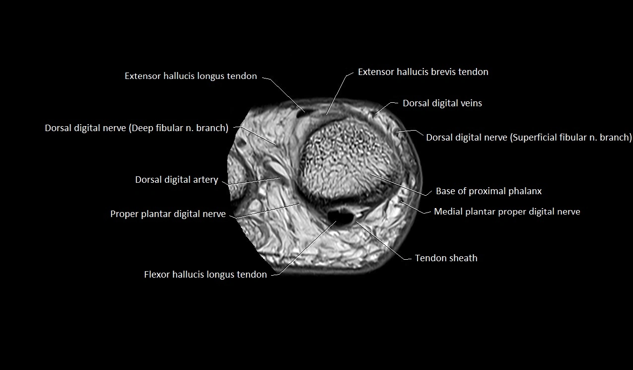Great toe (hallux) axial microanatomy 3T MRI image 21.webp